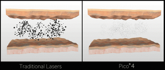 Voorbeeld hoe de inkdeeltjes opgelost worden in uw huid d.m.v. de Pico Laser